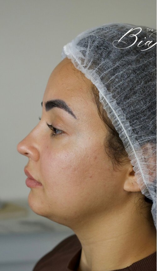 Depois da harmonização orofacial