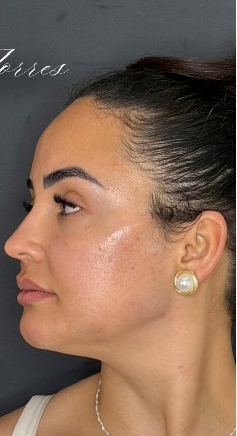 Antes da harmonização orofacial