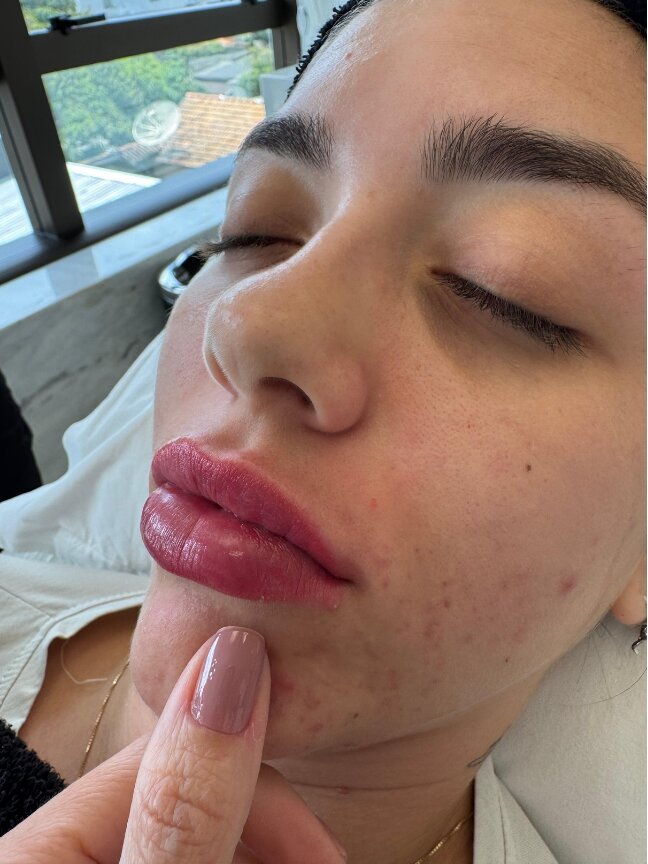 Antes do preenchimento labial