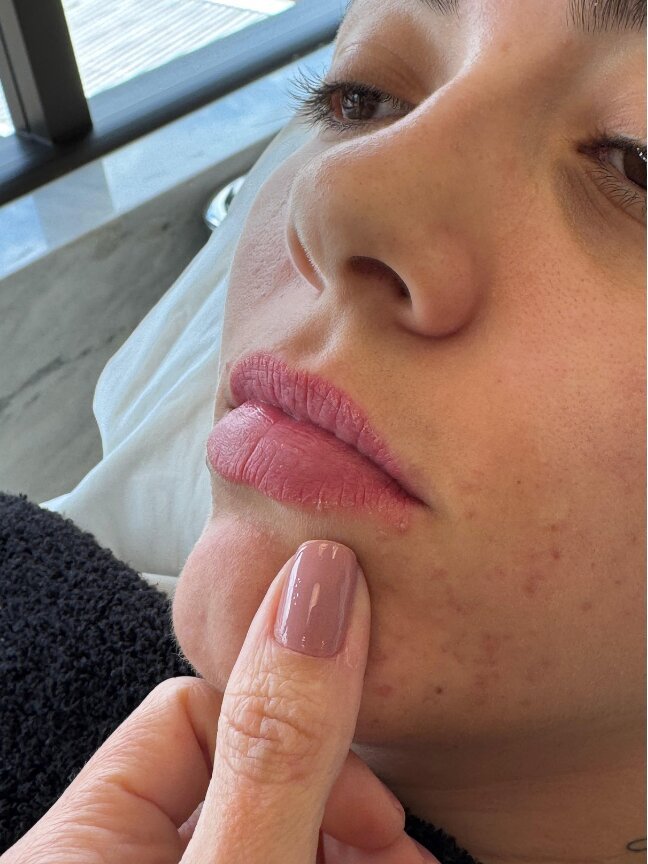Depois do preenchimento labial
