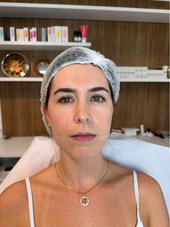 Preenchimento Labial