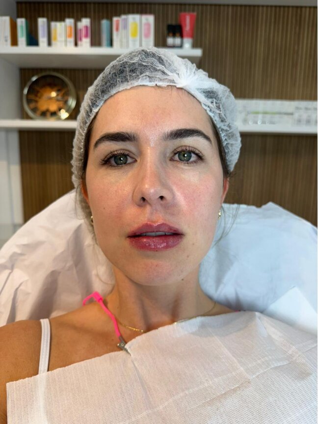 Preenchimento Labial